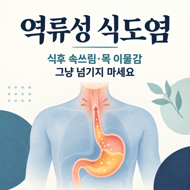 식후 속쓰림 목 이물감 역류성 식도염 증상 510만 명 시대의 2026년 대처법
