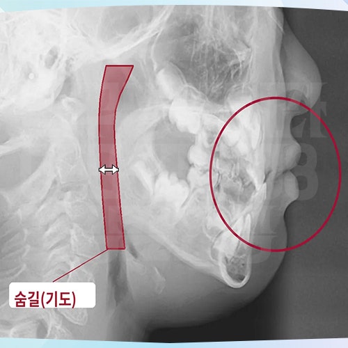 어린이 부정교합과 키성장, 따로 보지 마세요