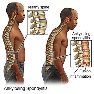 강직성 척추염 Ankylosing Spondylitis: “허리가 굳는 병”이라고 부르기 전에, 젊은 사람의 밤부....