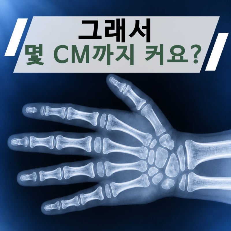 아이 성장판검사 해볼까 고민했는데… 예상키보다 먼저 알게 되는 "뼈나이"
