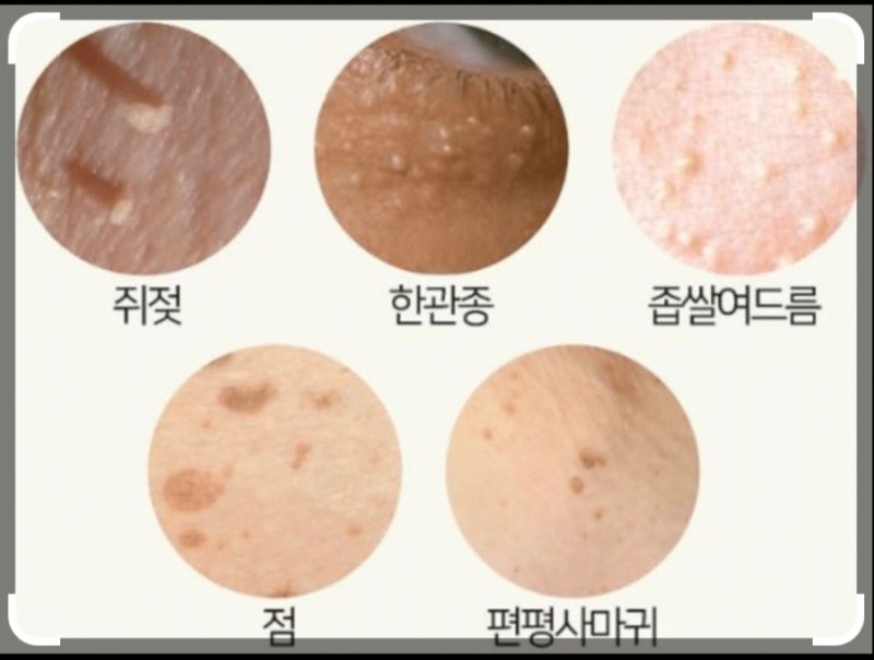 쥐젖이 갑자기 많아졌다면 인슐린 저항성 때문일까? 당뇨 전단계와 혈당검사까지 알아보기