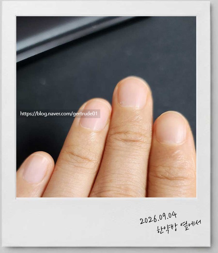 손톱 세로줄, 영양제만 먹으면 괜찮아질까?