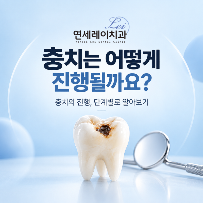 충치는 어떻게 진행될까요? 충치의 진행, 단계별로 알아보기