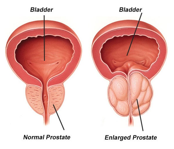 전립선비대증 Benign prostatic hyperplasia BPH 의료진 병원 진료·연구 디렉토리 2026