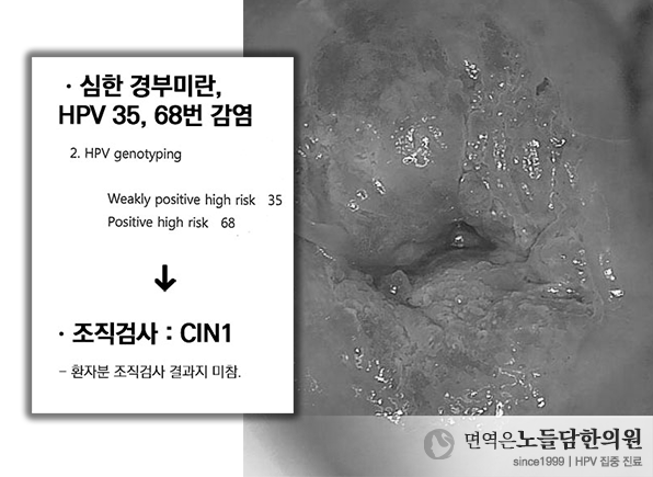 자궁경부이형성증, 대학병원과 로컬병원 검사 결과가 다른 이유와 상태 해석하기