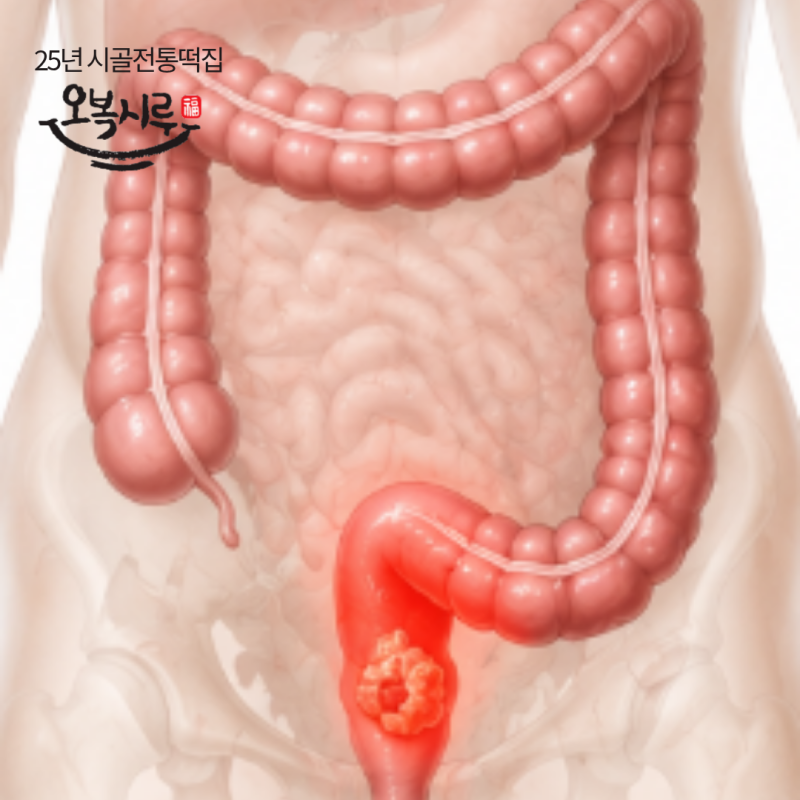 직장암 저위전방절제술, 생존율은 수술법보다 ‘병기’가 더 중요합니다