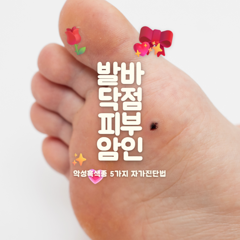 악성흑색종 발바닥 점과 구별하는 5가지 자가진단법과 골든타임