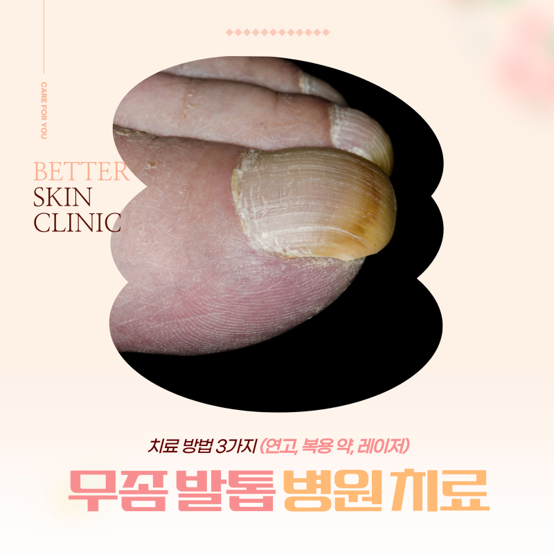 김량장동 무좀발톱병원 치료 방법 3가지 (연고, 복용 약, 레이저)