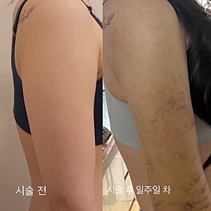 [팔뚝 람스 1주차 후기] 찐쫄보예신 교대 365mc 멍, 통증, 붓기 현실후기
