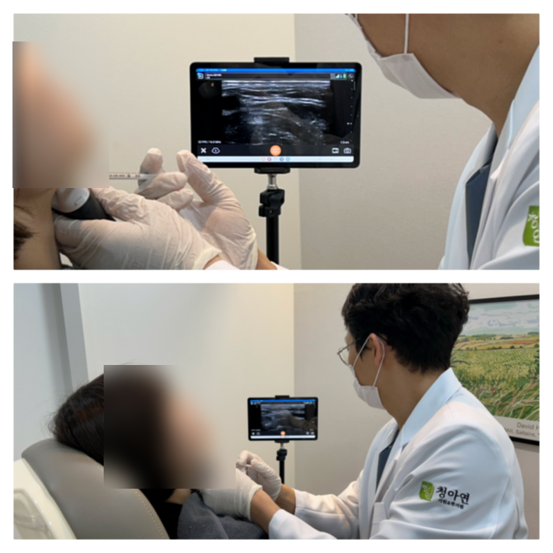 [강남 턱보톡스 잘하는곳] 둔탁한 하관의 진짜 원인 타파! 턱지방 주사 및 초음파 시술 리얼 ....