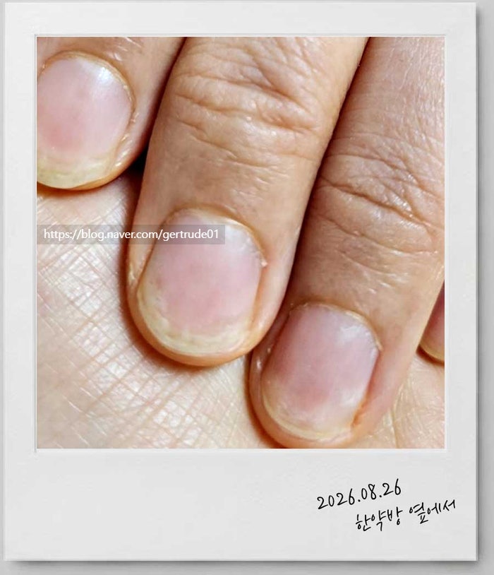 손톱 조갑박리증, 네일아트 때문만은 아니었다