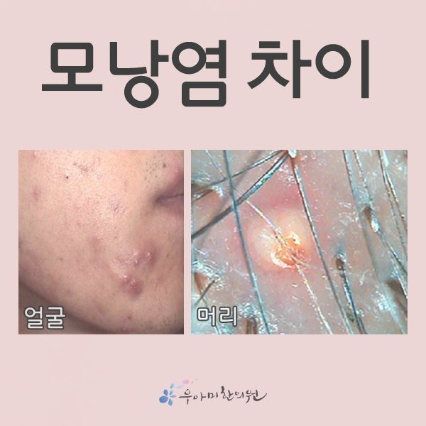 모낭염 압출, 필요한 경우와 그렇지 않은 경우는 다릅니다