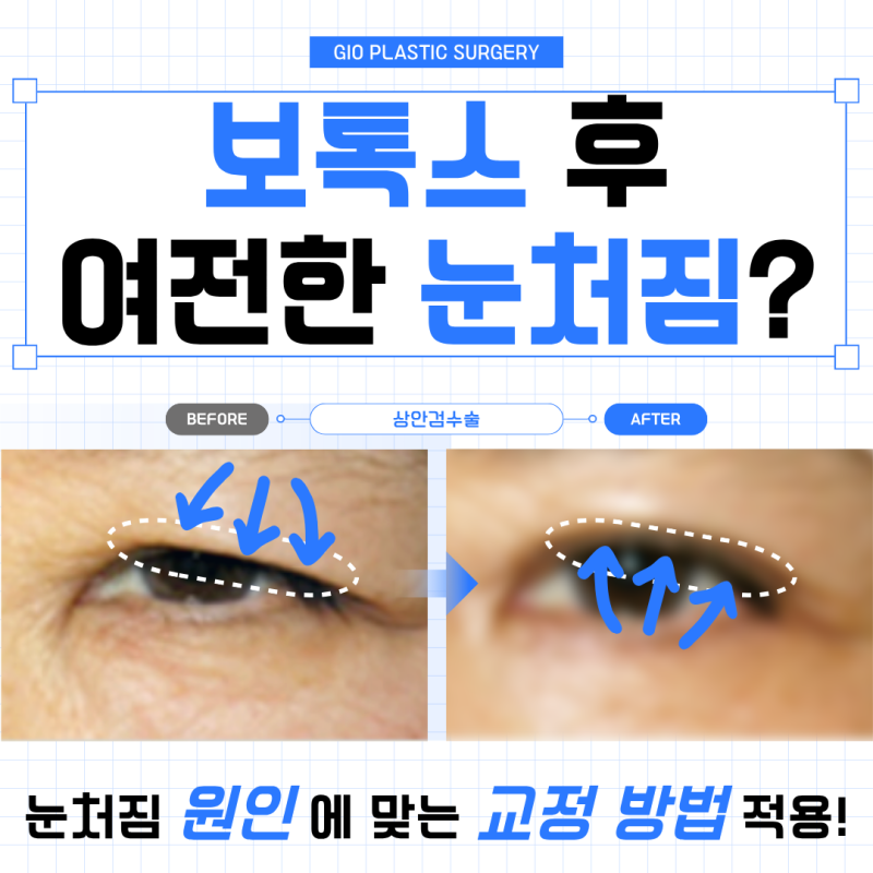 눈처짐 보톡스 효과 떨어질때 상안검수술 비용 알아봐요