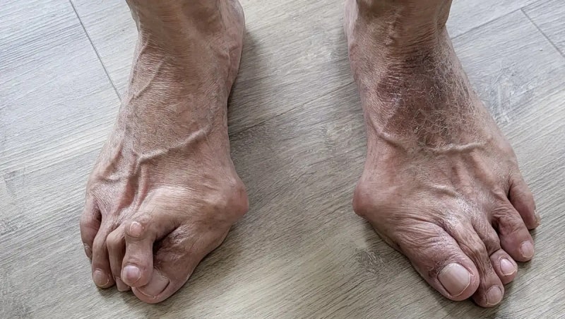 류마티스관절염 Rheumatoid arthritis RA 의료진 병원 진료·연구 디렉토리 2026
