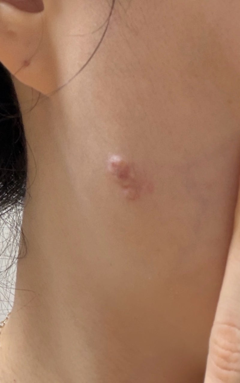 켈로이드 주사 한 달마다 맞고 총 3번 맞은 결과, 상태