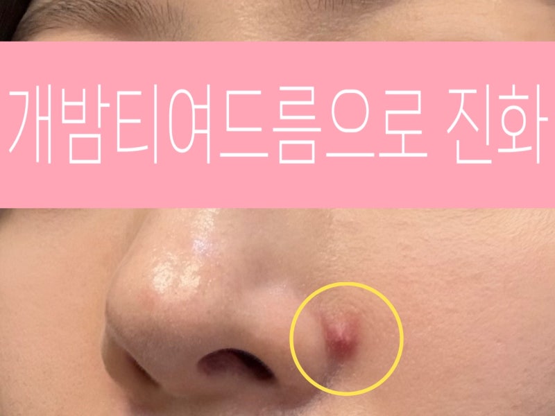 강남 염증성 여드름 염증주사 + 압출 피부과 내돈내산 후기｜하루만에 가라앉은 경과
