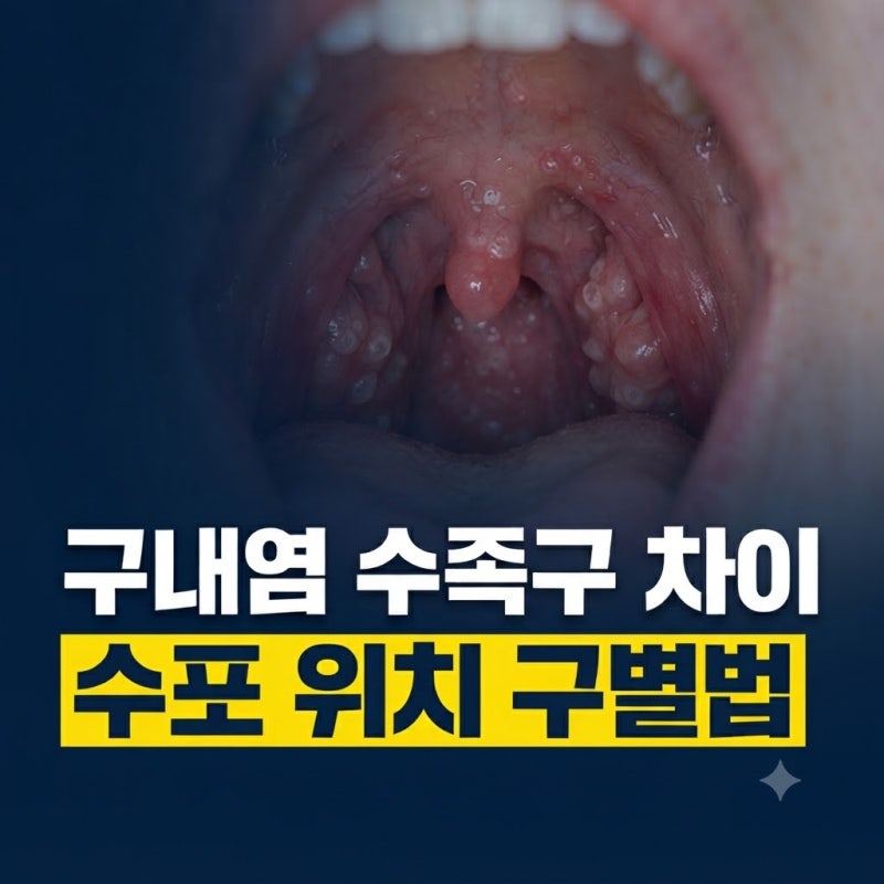 입안에만 났는데 수족구일까? 구내염 수족구 결정적 차이와 수포 위치 구별법