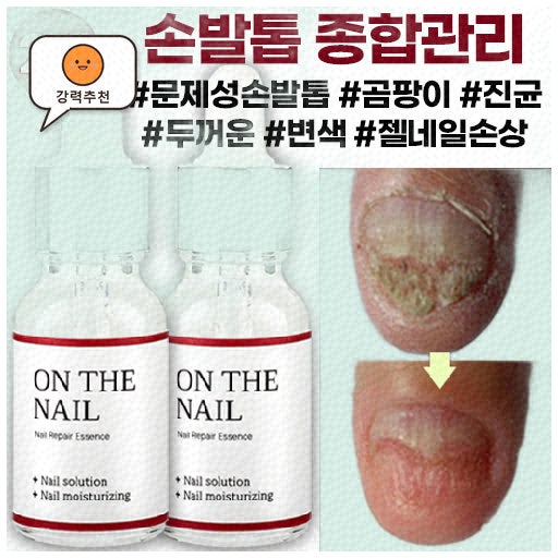 효과 좋은 발톱무좀패치 추천으로 건강한 손발 관리하기