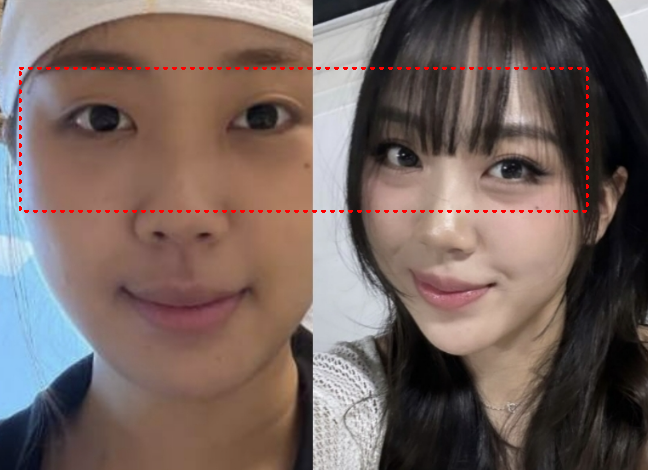 "Customers Recognize Me Immediately?" Lee Young-ji's Under-Eye Fat Repositioning After 4 Years of Deliberation, It's Not About Removing...