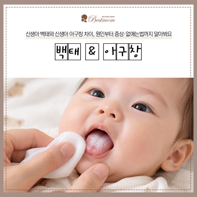 신생아 백태와 신생아 아구창 차이, 원인부터 증상·없애는법까지 알아봐요