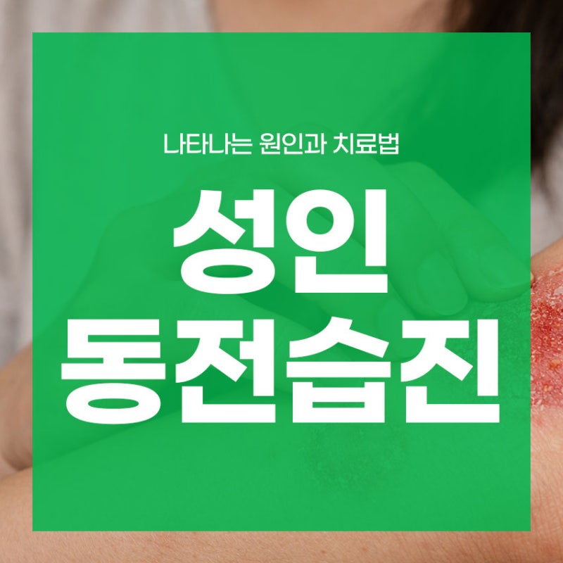 성인 동전습진 나타나는 원인과 치료법
