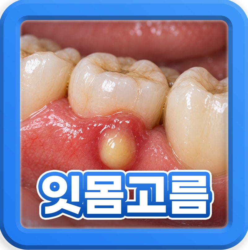 잇몸 고름 터져 냄새날 때 치주농양 짜도 될까?