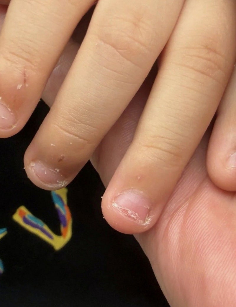 손톱뜯는버릇 고치기｜3주 만에 달라진 4살 아들 후기
