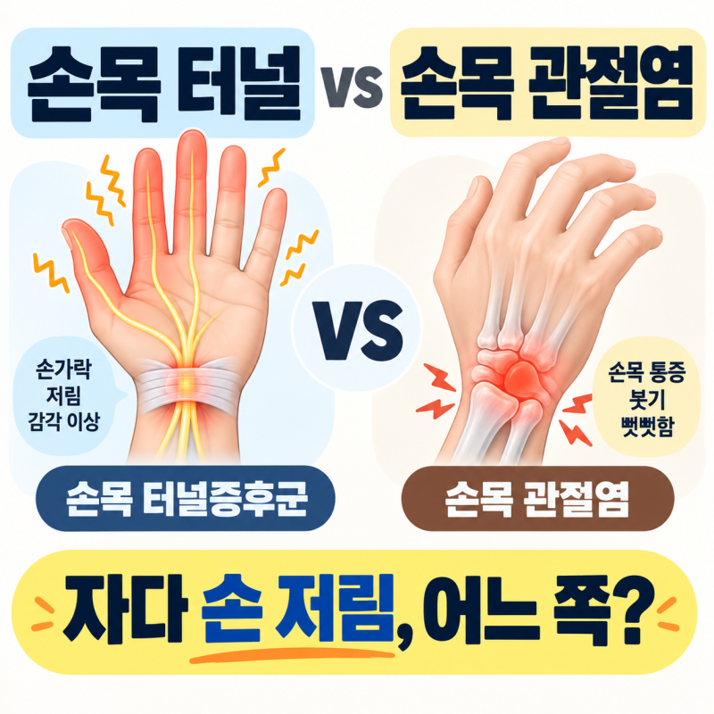 손목 터널 증후군 vs 손목 관절염 감별 기준 5단계, 저림·통증·밤 자다 깸·손 흔들기 반응