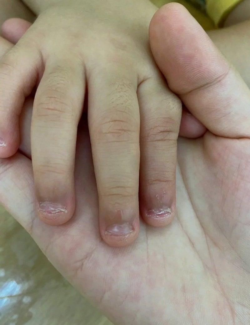 손톱뜯는버릇 고치기 3주째｜새로 뜯은 자국이 사라진 후기