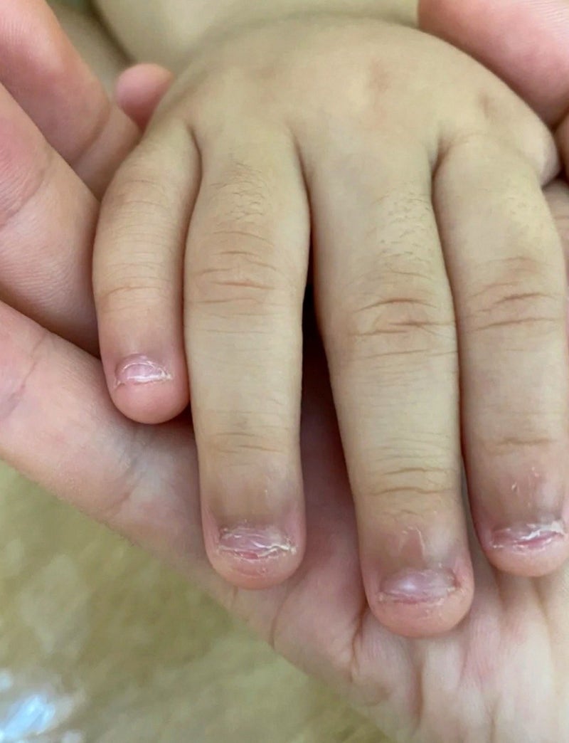 10살 아이 손톱뜯는버릇 초3인 지금도 매일 손톱이 짧아요