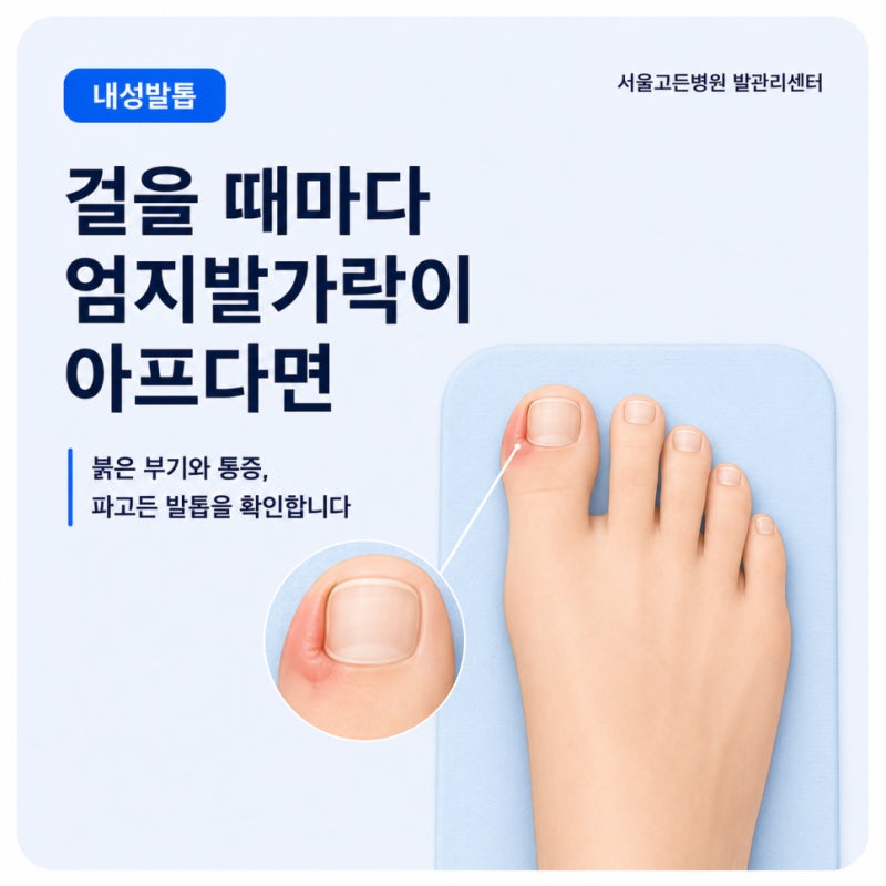 발톱 옆이 붓고 아픈 내성발톱, 수술 전에 교정치료부터 살펴봅니다 #강서구내성발톱