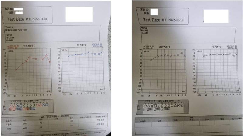해운대역 이명, 청력검사 정상인데 왜?