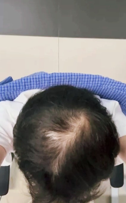 남자 탈모약 정수리 탈모가 계속된 이유 3개월 관리 후 변화