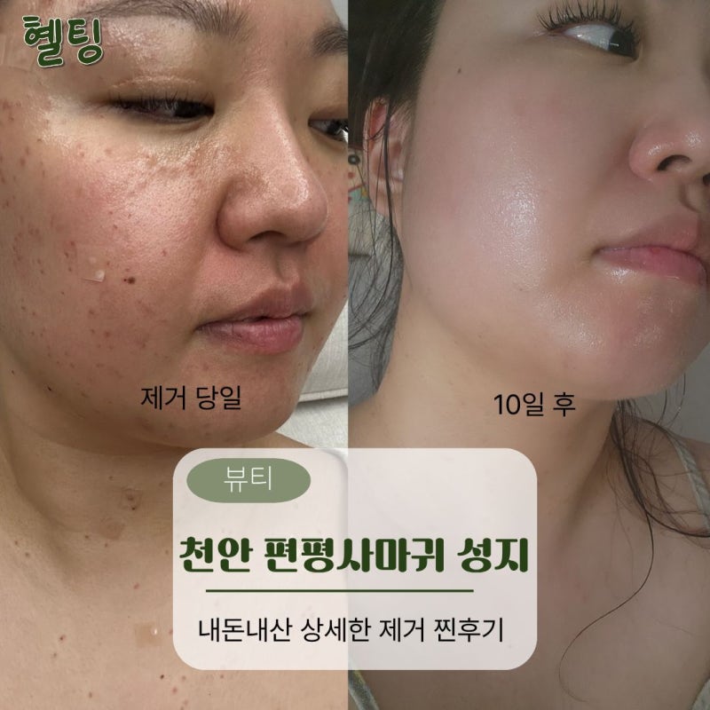 천안 편평사마귀 성지 켈로이드 피부 얼굴·목 제거 11일 경과 후기