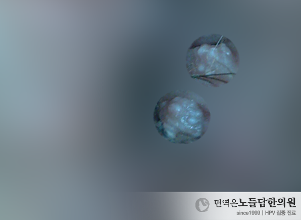 뾰루지 같은 항문 곤지름 증상, 제거 안 하고 놔두면 사라질 수 있나요?