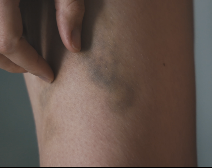 백혈병 멍은 어떻게 나타날까? 이유 없이 자꾸 생긴다면 확인할 신호