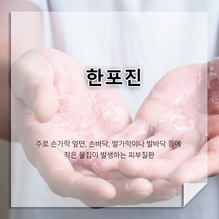 손이나 발에 작은 물집이 반복된다면? 한포진