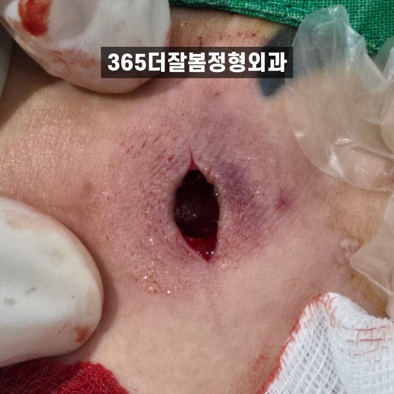 서울 피지낭종 당일수술, 가슴에 생긴 작은 혹 통증까지 느껴진