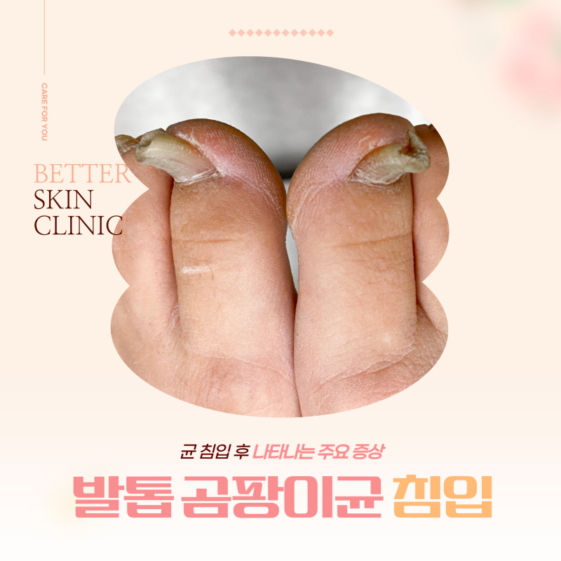 발톱 곰팡이균 침입 후 나타나는 주요 증상