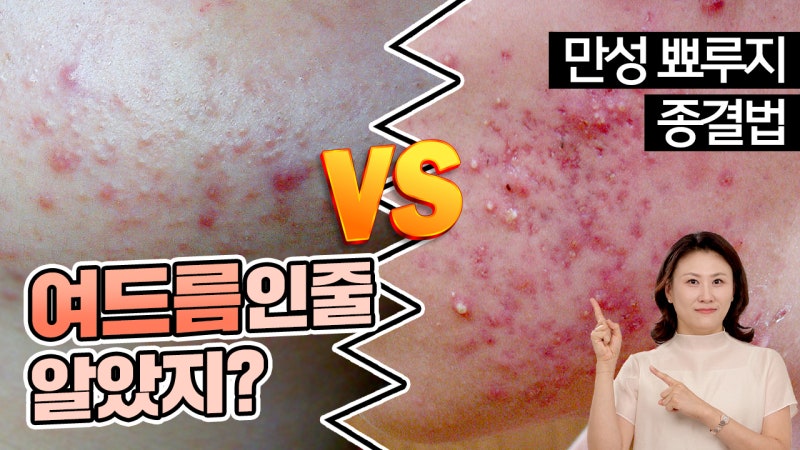 피부과 가도 안낫는 모낭염, 재발의 고리를 끊으려면 이것 하세요 ft. 여드름 패치, 항생제, ....