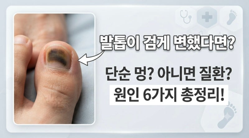 발톱이 검게 변했을 때 원인 6가지｜단순 멍과 무서운 질환 구별하는 방법