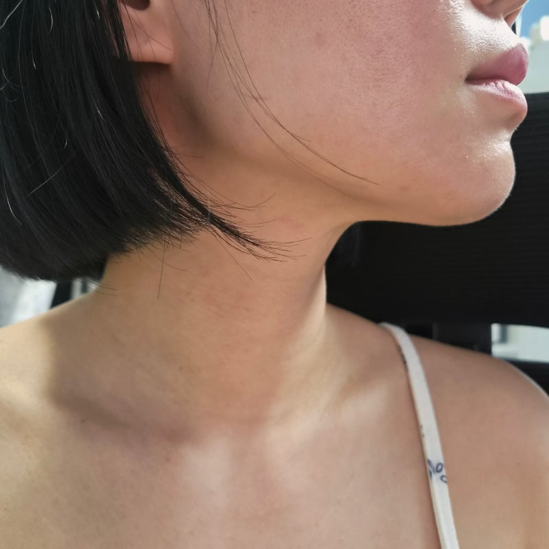 청담 피부과 목주름 필러 가격 효과 그리고 가로 목주름 삭제 전후 과정까지