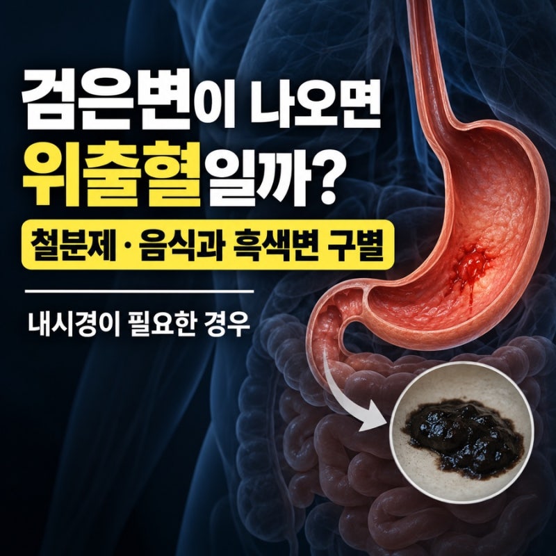 검은변이 나오면 위출혈일까? 철분제·음식과 흑색변 구별, 내시경이 필요한 경우