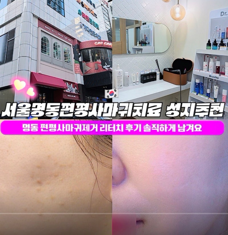 서울명동 편평사마귀치료 성지추천 2탄, 내돈내산 리터치 후기 솔직하게 남겨요