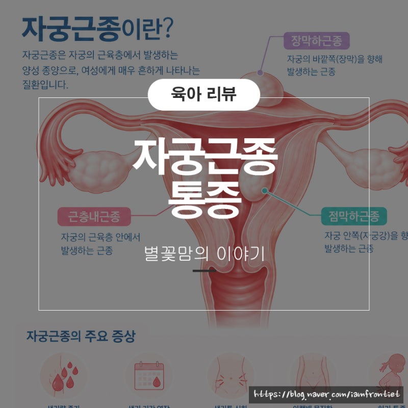 자궁근종 원인 통증 수술 알아보기