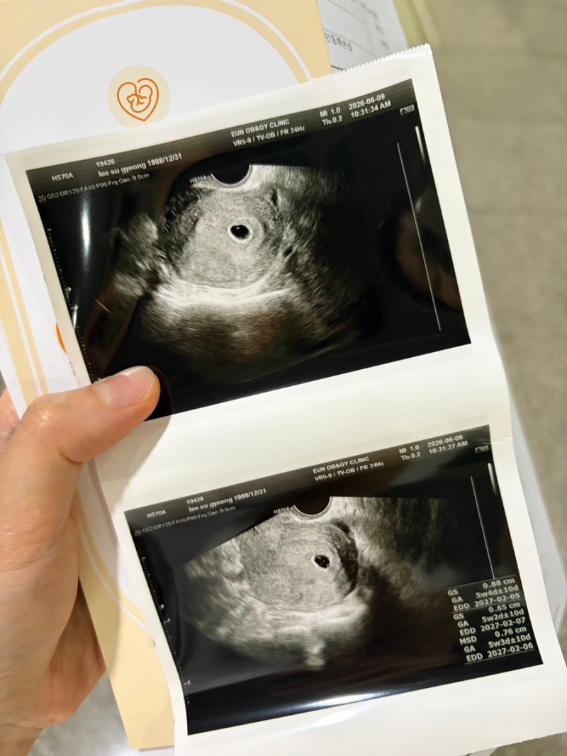 임신 9주 차 계류유산- 초기 유산 기록