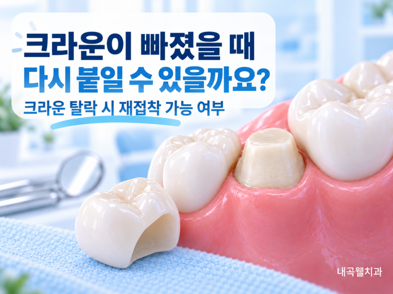 크라운이 빠졌을 때 다시 붙일 수 있을까요?