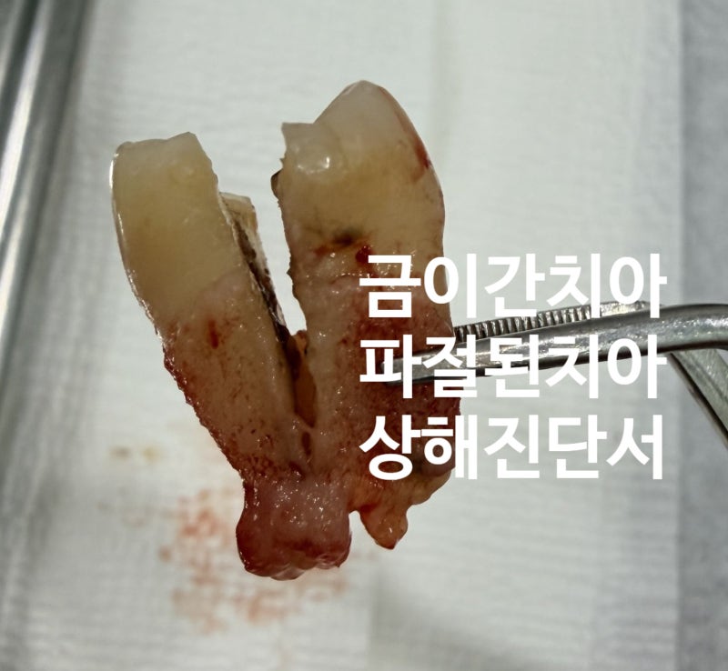 치아에 금이 갔다는데… 치아파절 진단서를 받을 수 있을까?