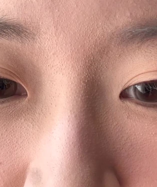 모공각화증, 모공이랑 뭐가 다른 걸까?