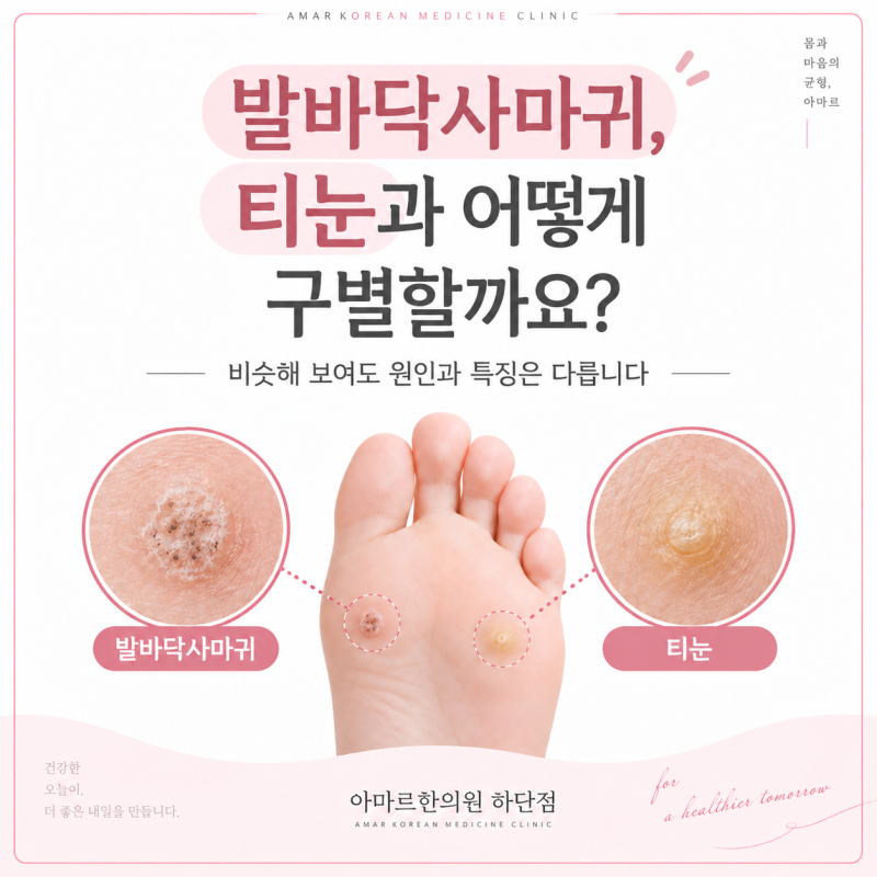 발바닥사마귀, 티눈과 어떻게 구별할까요?